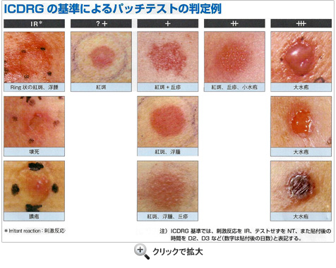 ICDRGの基準によるパッチテストの判定例:クリックで拡大