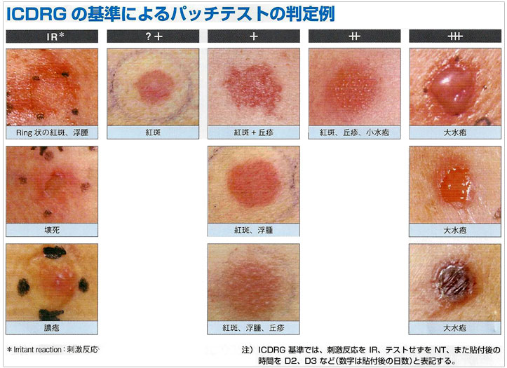 皮膚 科 で アレルギー 検査 できる